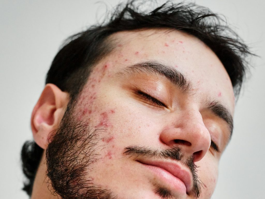 Nahaufnahme von Mann mit Acne und geschlossenen Augen, der seinen Kopf zur Seite neigt